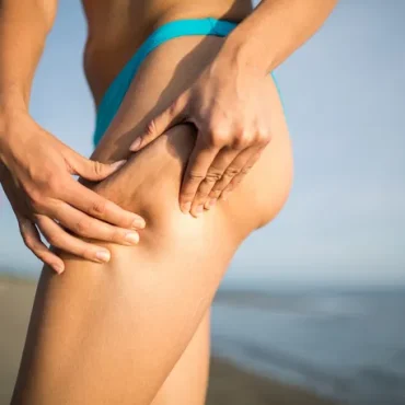 mulher com celulite nas pernas