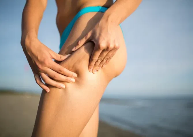 mulher com celulite nas pernas